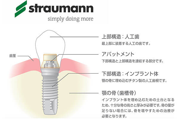 インプラントとは